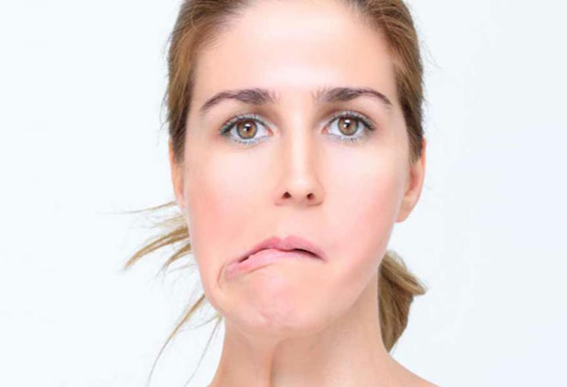 Parálisis facial